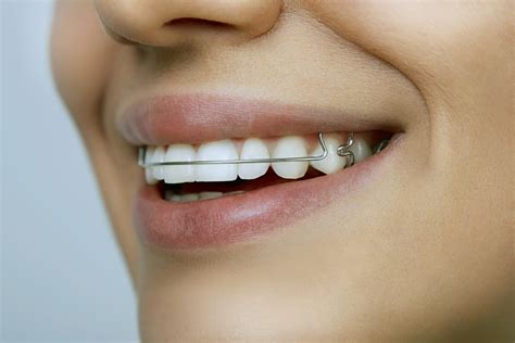 metal bracket on lower teeth how long to keep on|permanent braces for teeth.